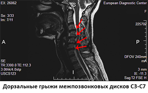 МРТ шейного отдела позвоночника