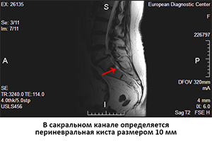 киста в сакральном канале