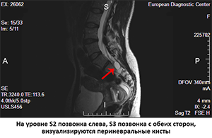 МРТ поясничного отдела позвоночника