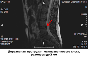 мрт поясницы, протрузия диска